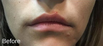 Injectables Before & After Gallery - Patient 300130 - Image 1