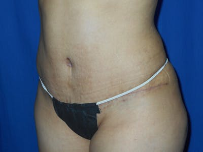 Tummy Tuck Before & After Gallery - Patient 289675 - Image 2