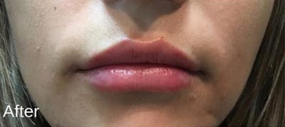 Injectables Before & After Gallery - Patient 300130 - Image 2