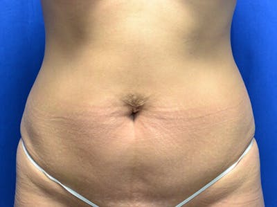 Tummy Tuck Before & After Gallery - Patient 105735 - Image 1