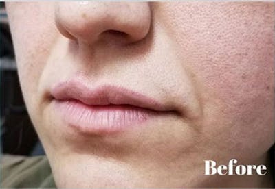 Injectables Before & After Gallery - Patient 139327 - Image 1
