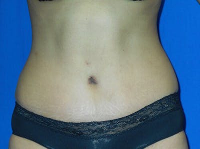 Tummy Tuck Before & After Gallery - Patient 105735 - Image 2