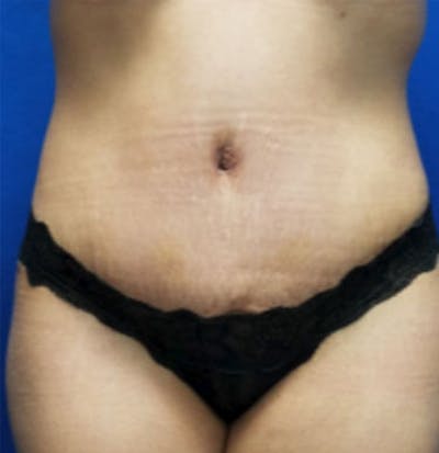Mommy Makeover Before & After Gallery - Patient 428982 - Image 2
