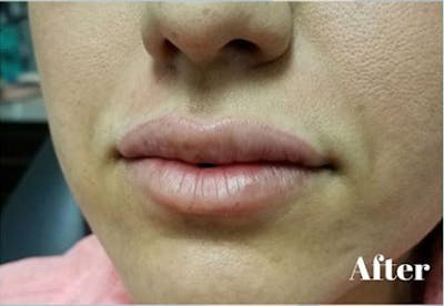Injectables Before & After Gallery - Patient 139327 - Image 2