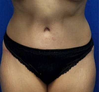Mommy Makeover Before & After Gallery - Patient 348301 - Image 1