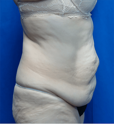 Tummy Tuck Before & After Gallery - Patient 196277 - Image 1