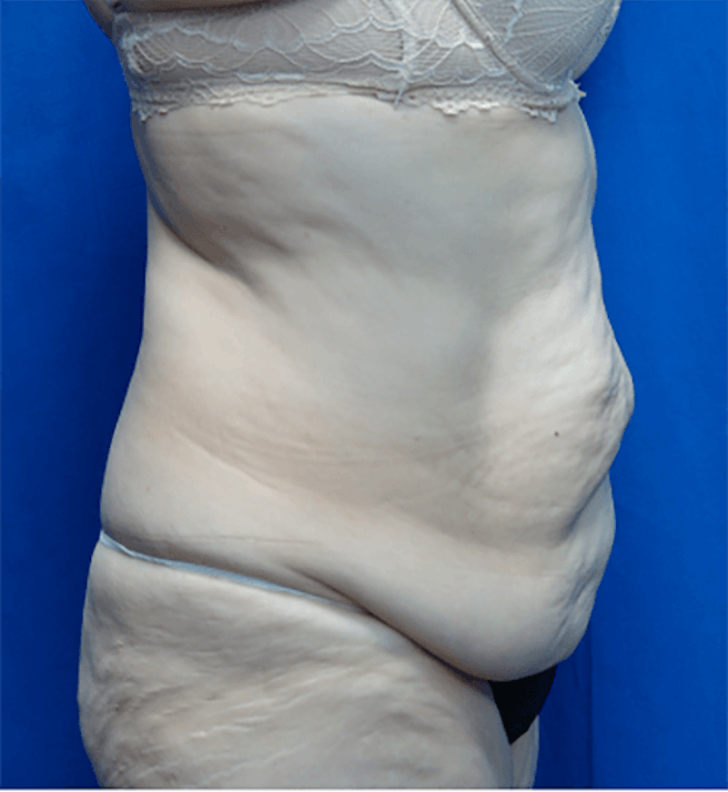 Tummy Tuck Before & After Gallery - Patient 196277 - Image 1