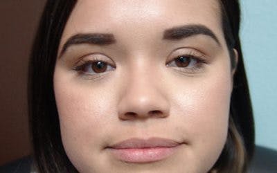 Injectables Before & After Gallery - Patient 103330 - Image 1