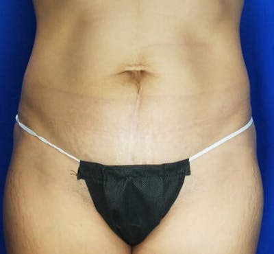Mommy Makeover Before & After Gallery - Patient 348301 - Image 2