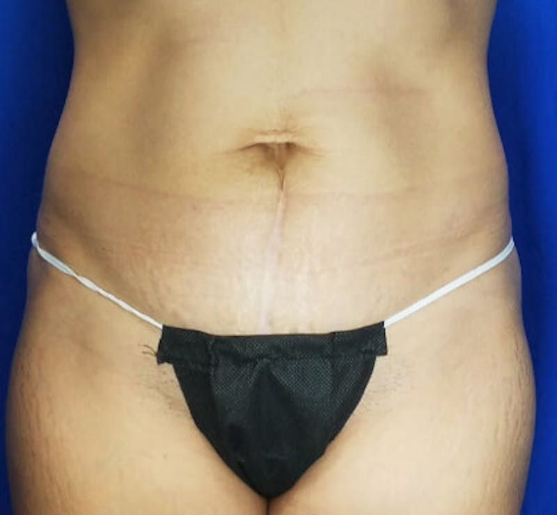 Mommy Makeover Before & After Gallery - Patient 348301 - Image 2