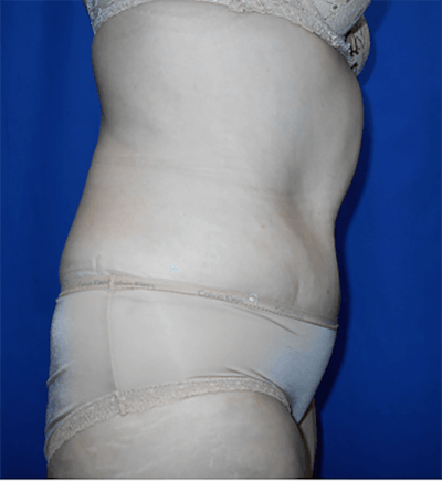 Tummy Tuck Before & After Gallery - Patient 196277 - Image 2