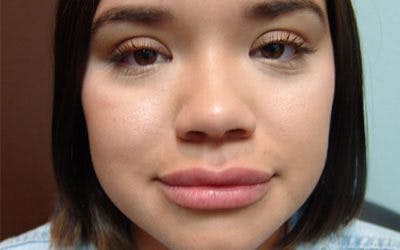Injectables Before & After Gallery - Patient 103330 - Image 2