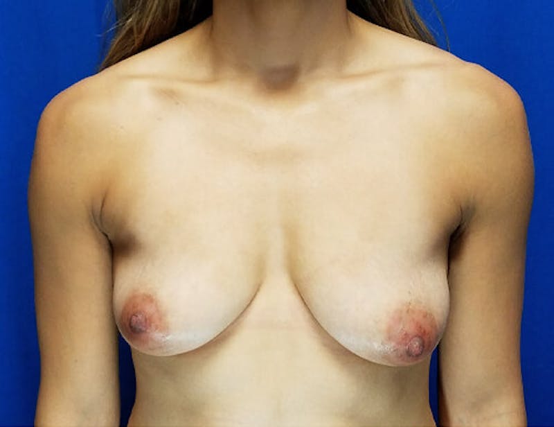Mommy Makeover Before & After Gallery - Patient 154393 - Image 1