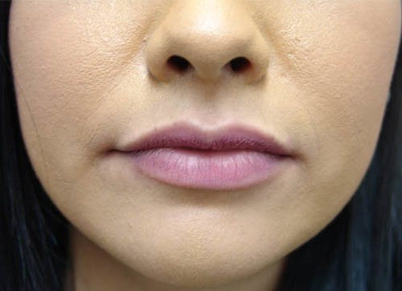 Injectables Before & After Gallery - Patient 400750 - Image 1