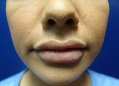 Injectables Before & After Gallery - Patient 400750 - Image 2