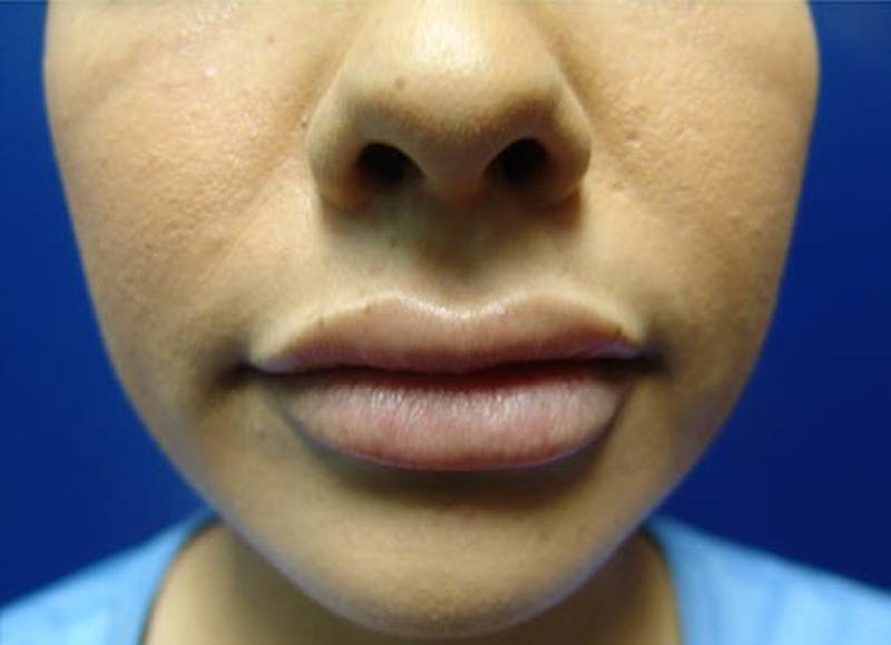 Injectables Before & After Gallery - Patient 400750 - Image 2