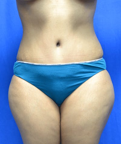 Tummy Tuck Before & After Gallery - Patient 376678 - Image 2