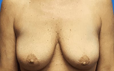 Breast Lift with Implants Before & After Gallery - Patient 373899 - Image 1