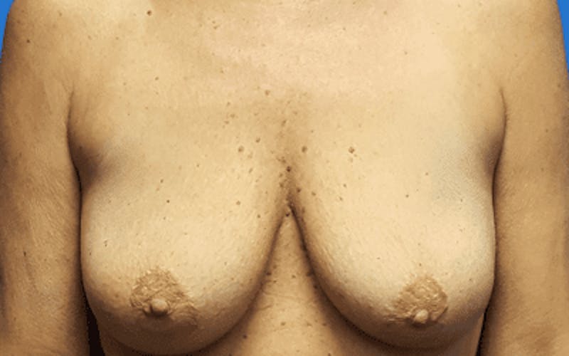 Breast Lift with Implants Before & After Gallery - Patient 373899 - Image 1