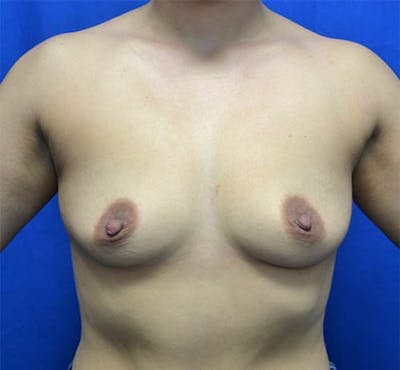 Mommy Makeover Before & After Gallery - Patient 158794 - Image 1