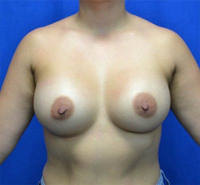 Mommy Makeover Before & After Gallery - Patient 158794 - Image 2