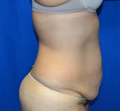 Tummy Tuck Before & After Gallery - Patient 359774 - Image 1
