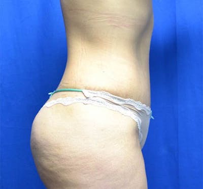 Tummy Tuck Before & After Gallery - Patient 359774 - Image 2