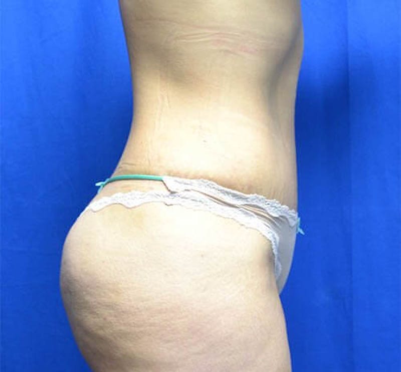 Tummy Tuck Before & After Gallery - Patient 359774 - Image 2