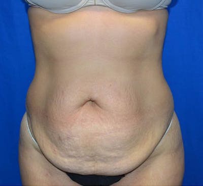 Tummy Tuck Before & After Gallery - Patient 171831 - Image 1