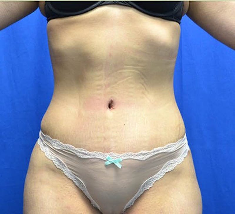 Tummy Tuck Before & After Gallery - Patient 171831 - Image 2