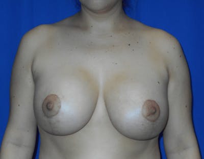 Breast Lift with Implants Before & After Gallery - Patient 418605 - Image 2