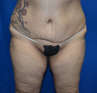 Tummy Tuck Before & After Gallery - Patient 876902 - Image 1