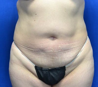 Tummy Tuck Before & After Gallery - Patient 369578 - Image 1