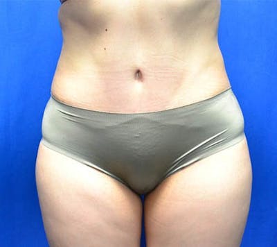 Tummy Tuck Before & After Gallery - Patient 369578 - Image 2