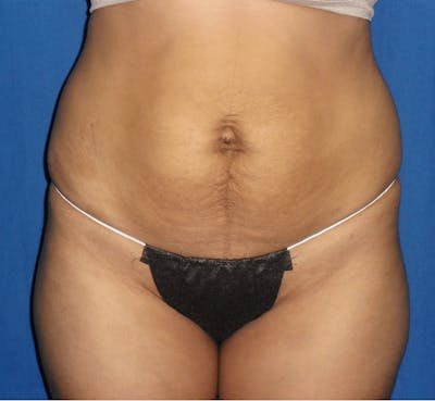 Tummy Tuck Before & After Gallery - Patient 463981 - Image 1