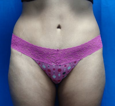 Tummy Tuck Before & After Gallery - Patient 463981 - Image 2