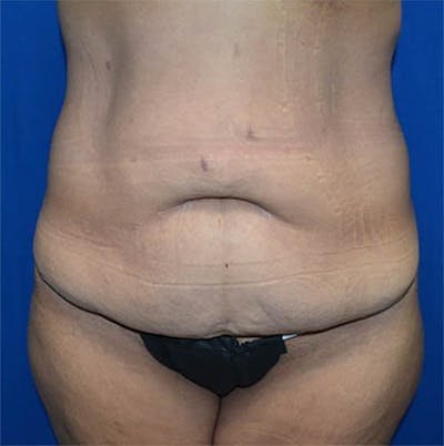 Tummy Tuck Before & After Gallery - Patient 328322 - Image 1