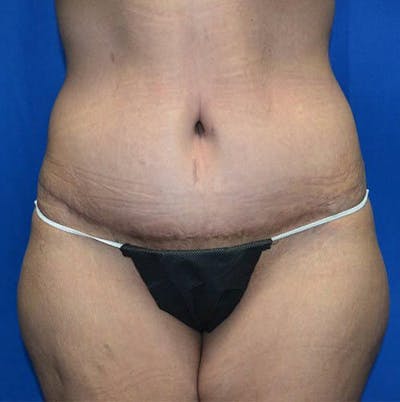 Tummy Tuck Before & After Gallery - Patient 328322 - Image 2