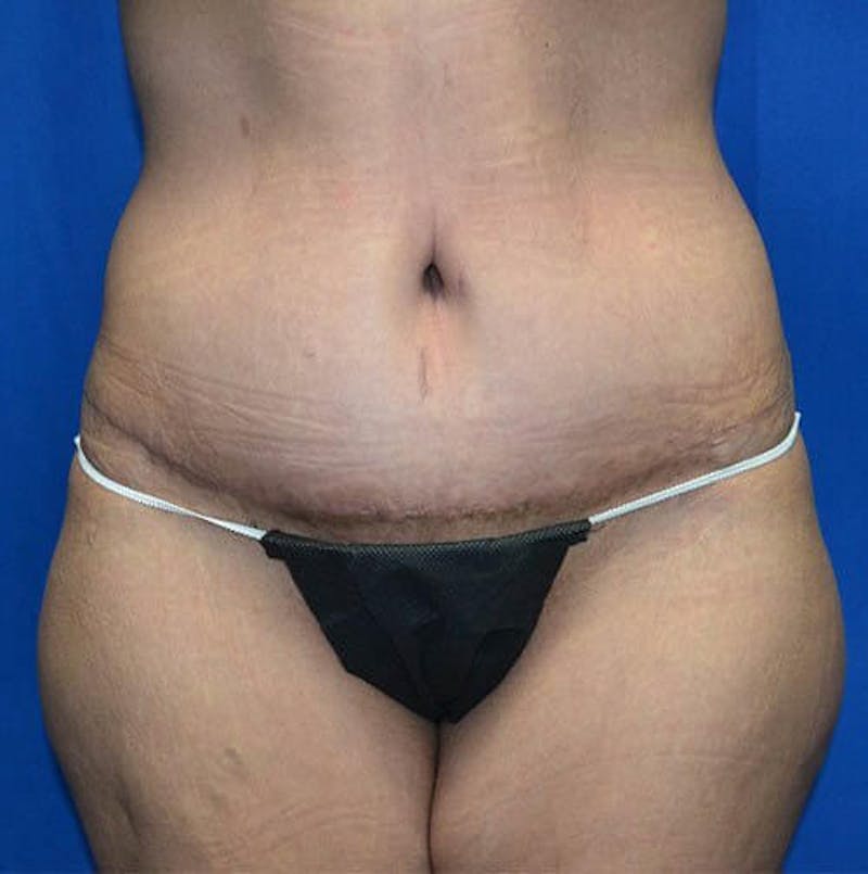 Tummy Tuck Before & After Gallery - Patient 328322 - Image 2