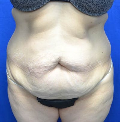 Tummy Tuck Before & After Gallery - Patient 332500 - Image 1