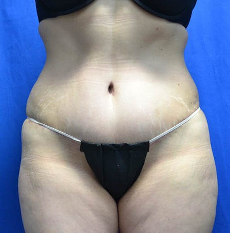 Tummy Tuck Before & After Gallery - Patient 332500 - Image 2