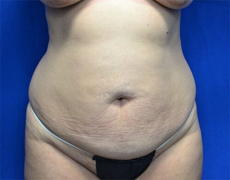 Tummy Tuck Before & After Gallery - Patient 383569 - Image 1