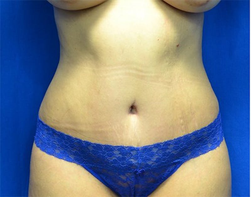 Tummy Tuck Before & After Gallery - Patient 383569 - Image 2