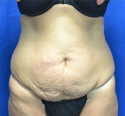 Tummy Tuck Before & After Gallery - Patient 383877 - Image 1