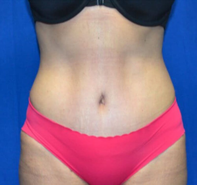 Tummy Tuck Before & After Gallery - Patient 383877 - Image 2