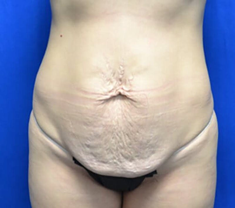 Tummy Tuck Before & After Gallery - Patient 366284 - Image 1