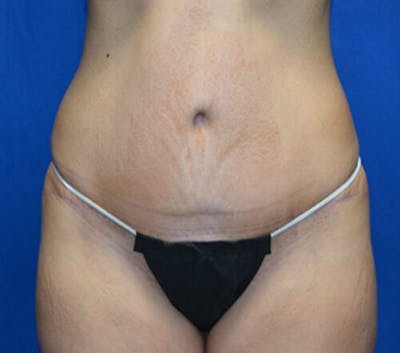Tummy Tuck Before & After Gallery - Patient 366284 - Image 2