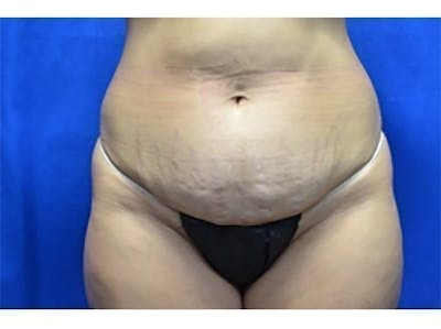 Tummy Tuck Before & After Gallery - Patient 185107 - Image 1