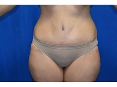 Tummy Tuck Before & After Gallery - Patient 185107 - Image 2