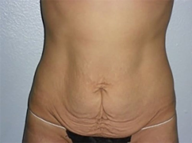Tummy Tuck Before & After Gallery - Patient 227453 - Image 1